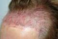 Hair Transplant - Making The Decision To Have Hair Transplant Surgery